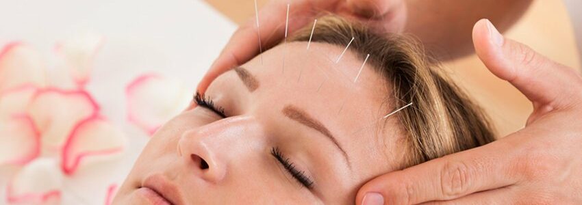 acupuncture lifting par l'acupuncture