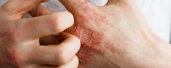 psoriasis en goutte