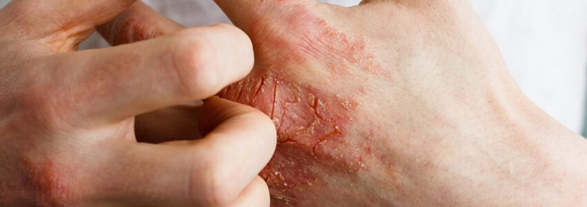 psoriasis en goutte